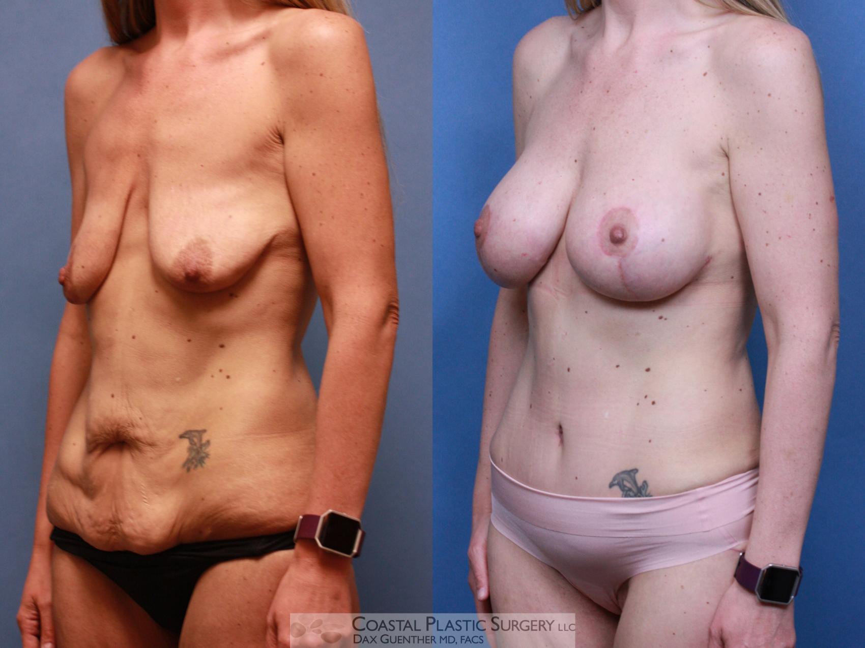 Before & After Mommy Makeover Case 118 Left Oblique View in Hingham, Boston & Nantucket, MA