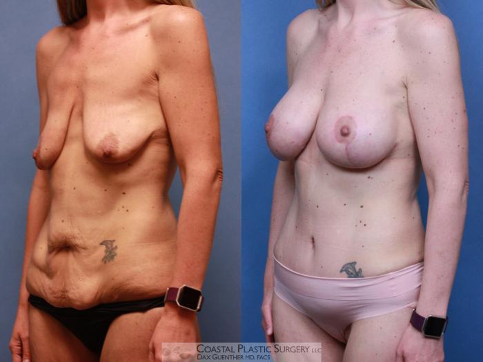 Before & After Mommy Makeover Case 118 Left Oblique View in Hingham, MA