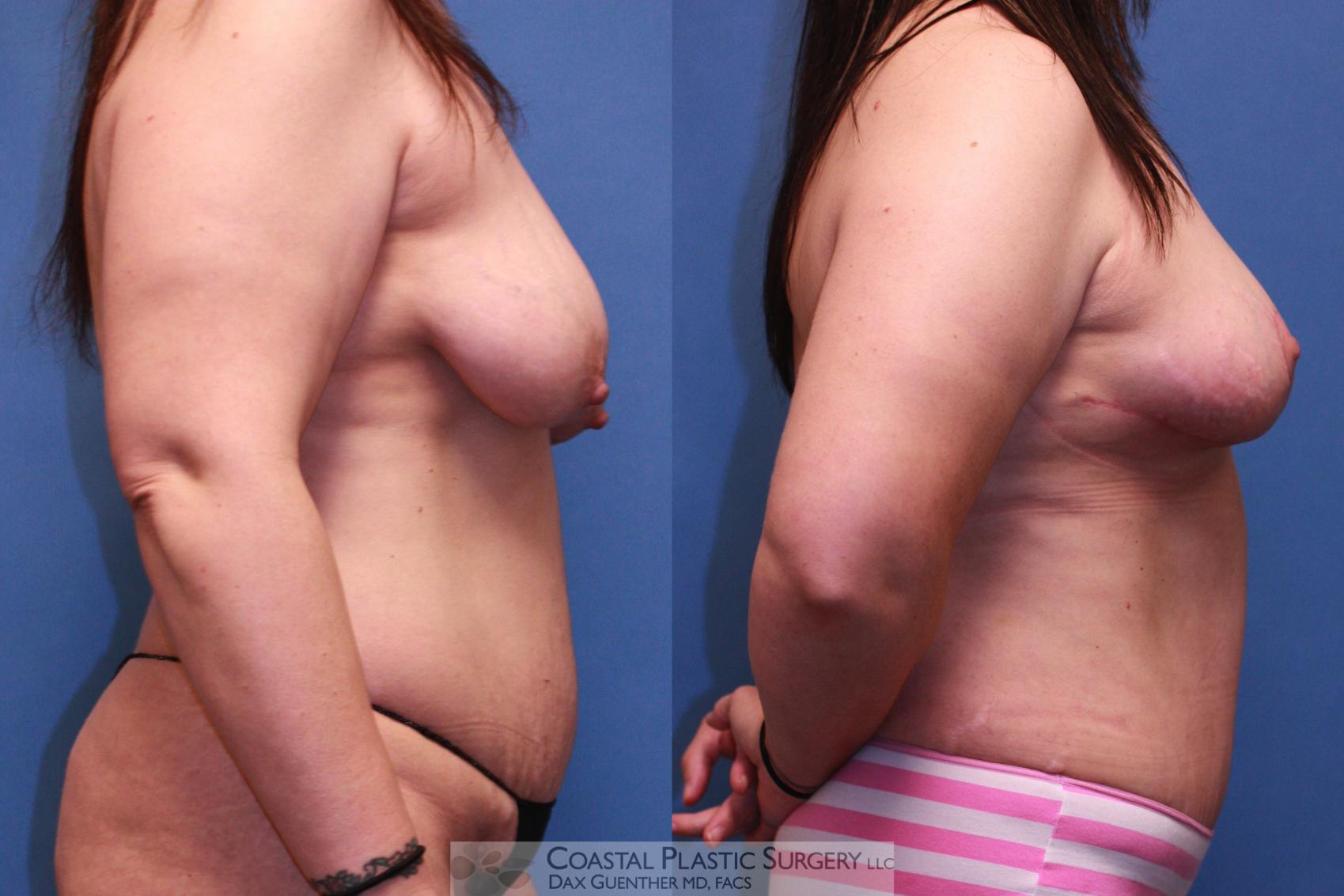 Before & After Mommy Makeover Case 29 View #3 View in Hingham, Boston & Nantucket, MA