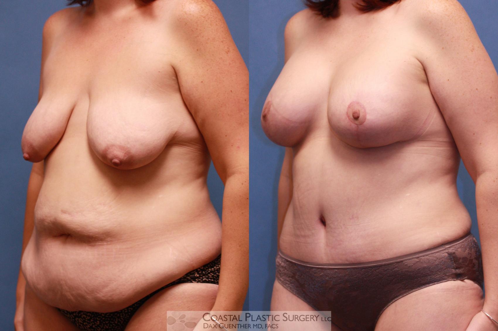Before & After Mommy Makeover Case 37 View #4 View in Hingham, Boston & Nantucket, MA