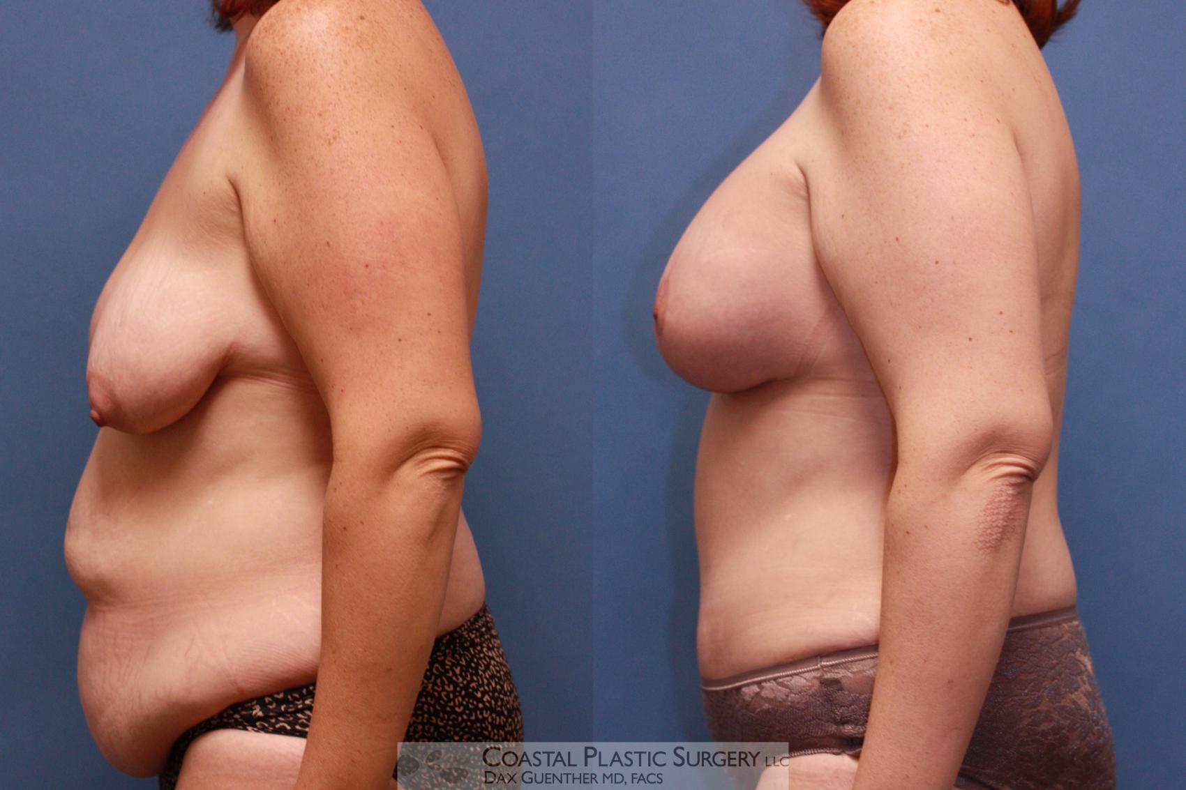 Before & After Mommy Makeover Case 37 View #5 View in Boston, MA