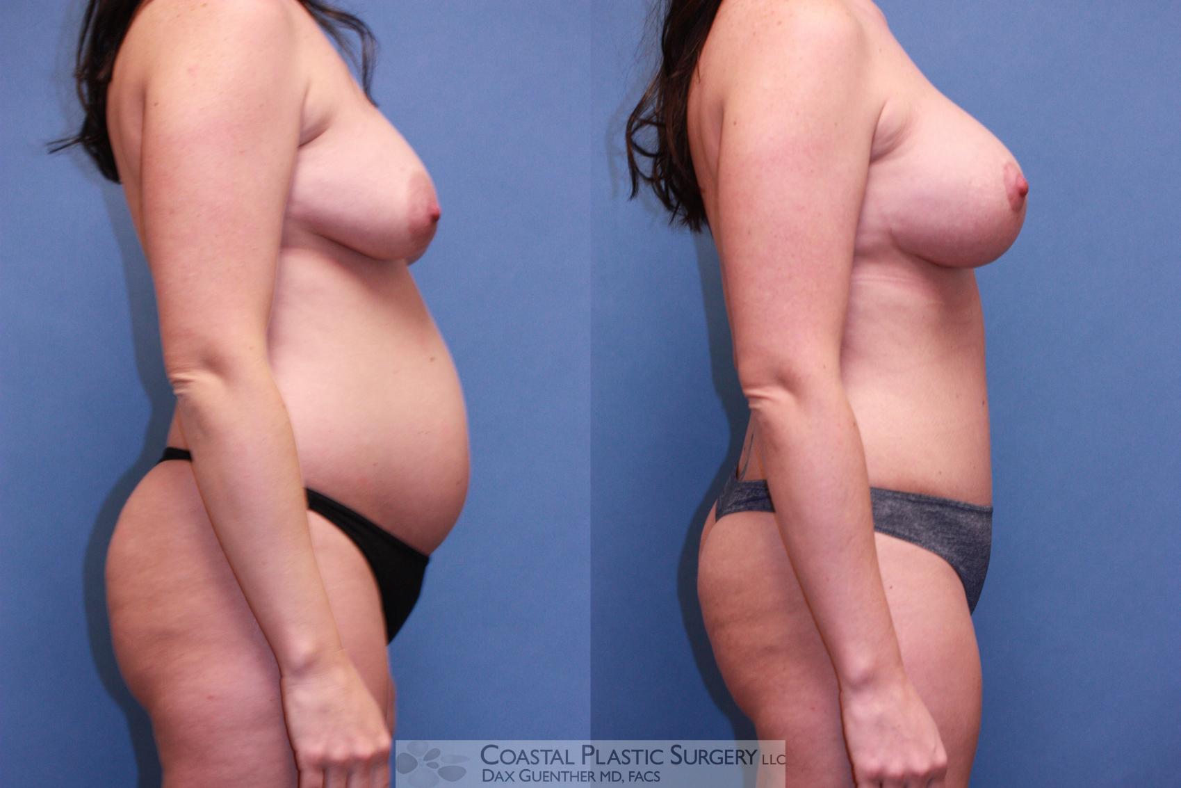 Before & After Mommy Makeover Case 50 View #2 View in Hingham, Boston & Nantucket, MA