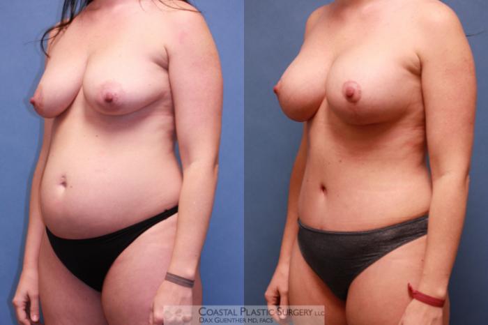 Before & After Mommy Makeover Case 50 View #3 View in Hingham, MA