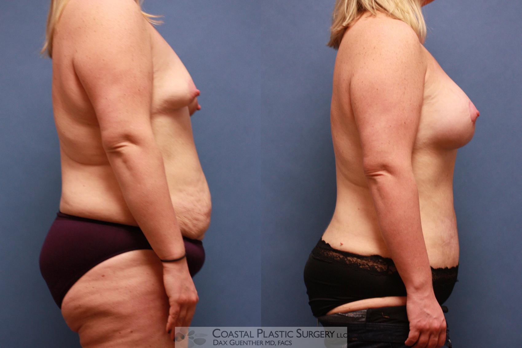 Before & After Mommy Makeover Case 84 View #3 View in Boston, MA