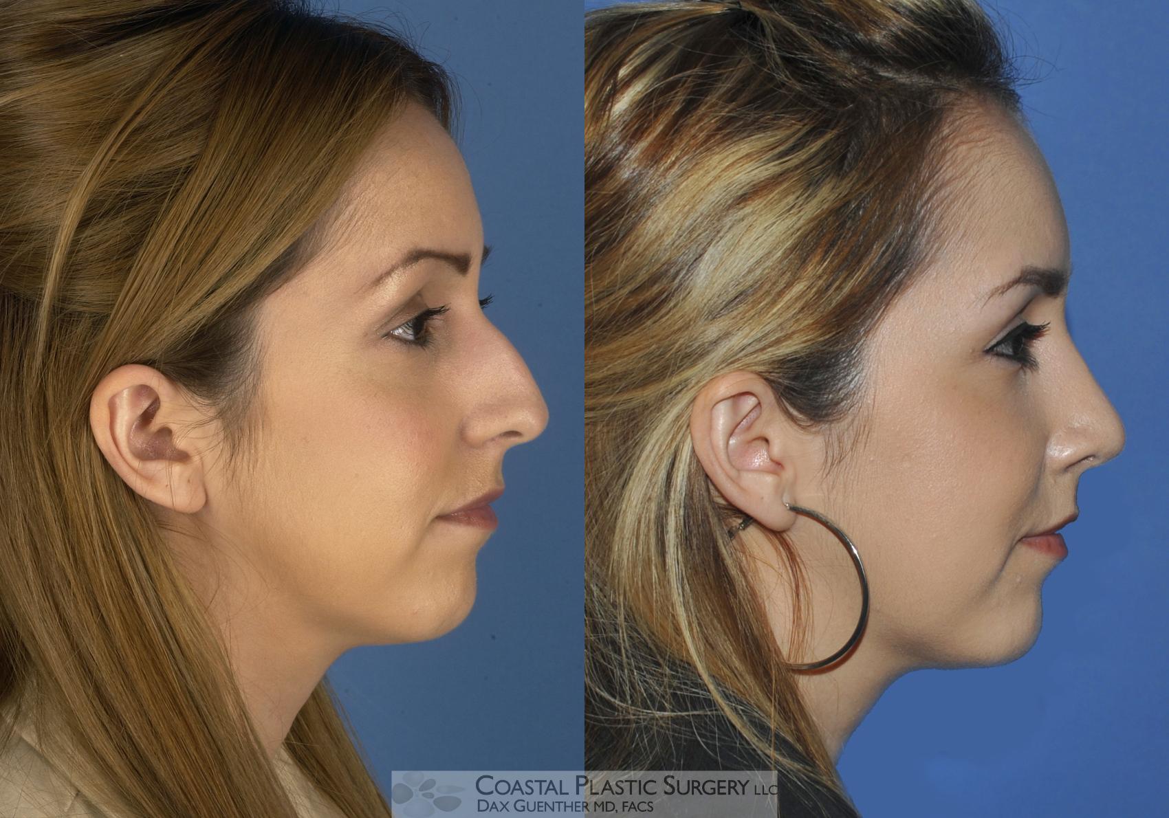 Before & After Rhinoplasty Case 1 View #1 View in Boston, MA
