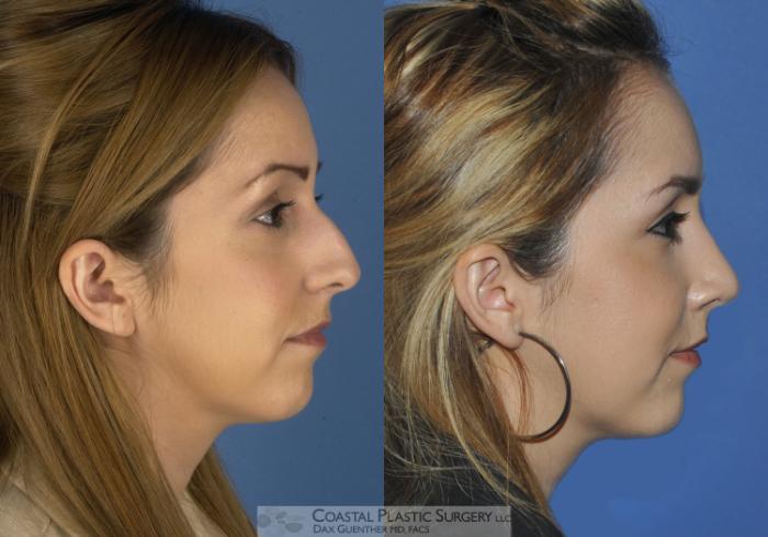 Before & After Rhinoplasty Case 1 View #1 View in Hingham, MA