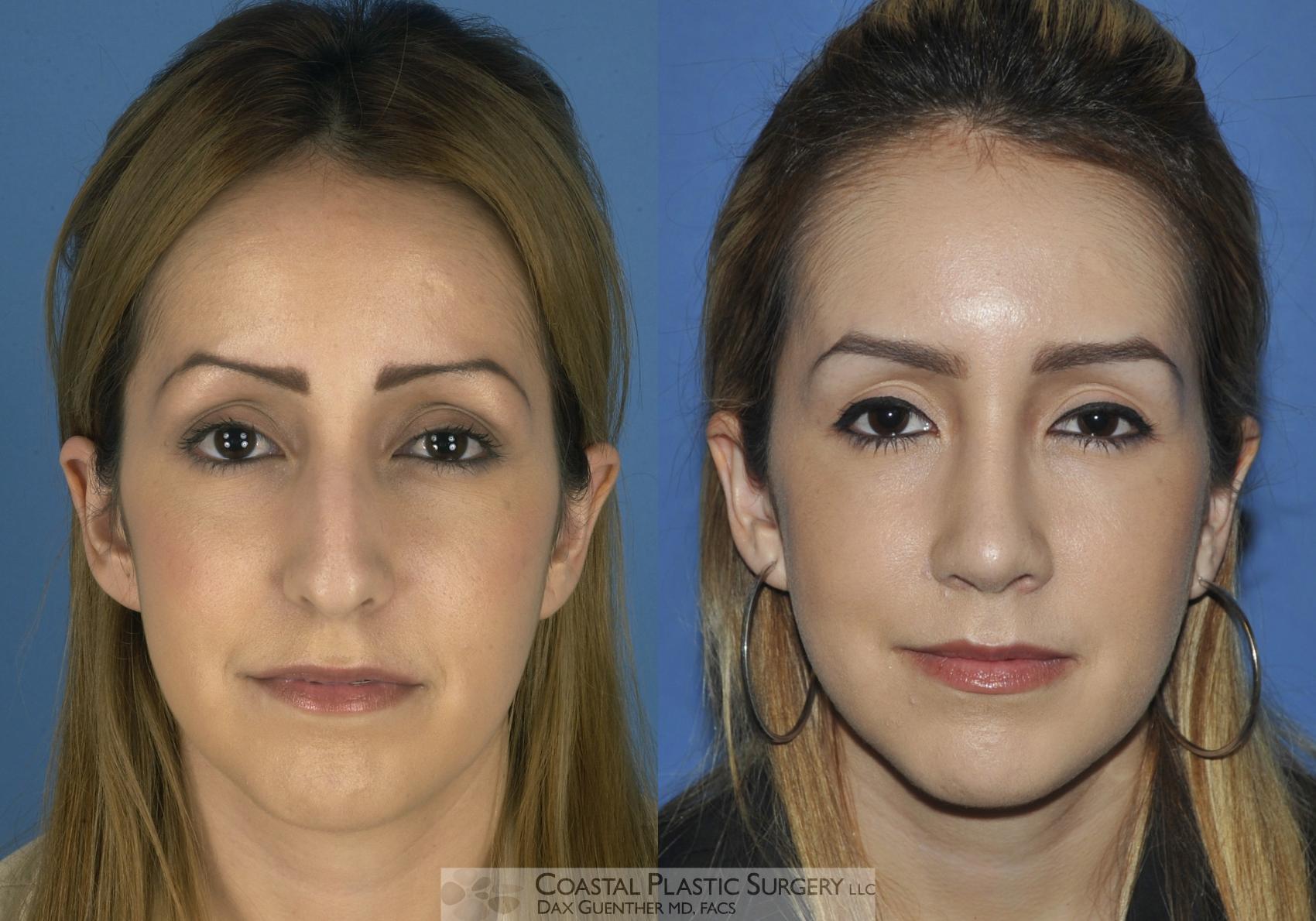 Before & After Rhinoplasty Case 1 View #2 View in Hingham, Boston & Nantucket, MA