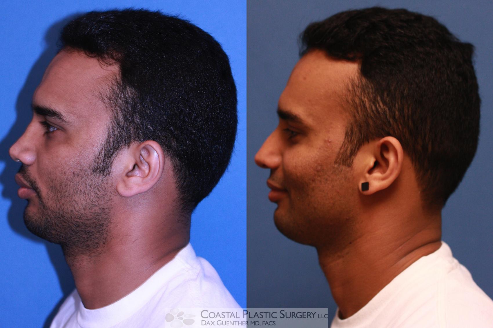 Rhinoplasty Before & After Photos Patient 22 Hingham, MA