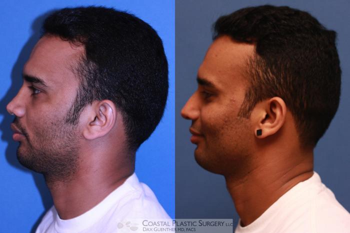 Before & After Rhinoplasty Case 22 View #4 View in Hingham, MA