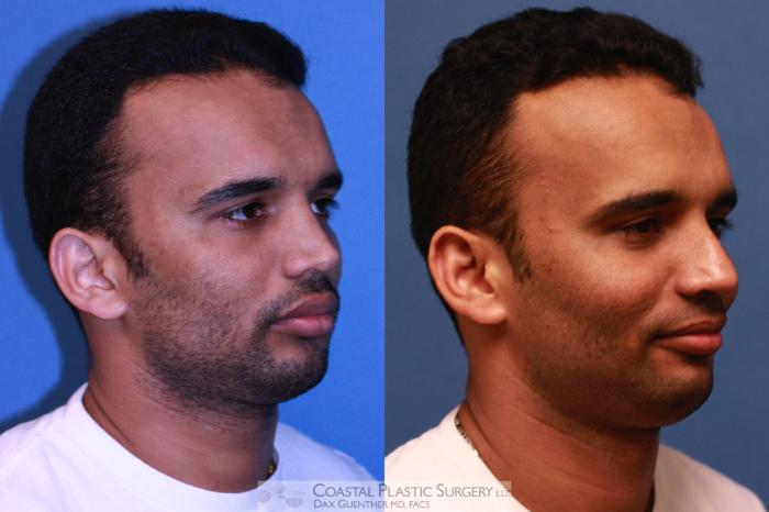 Before & After Rhinoplasty Case 22 View #6 View in Hingham, MA