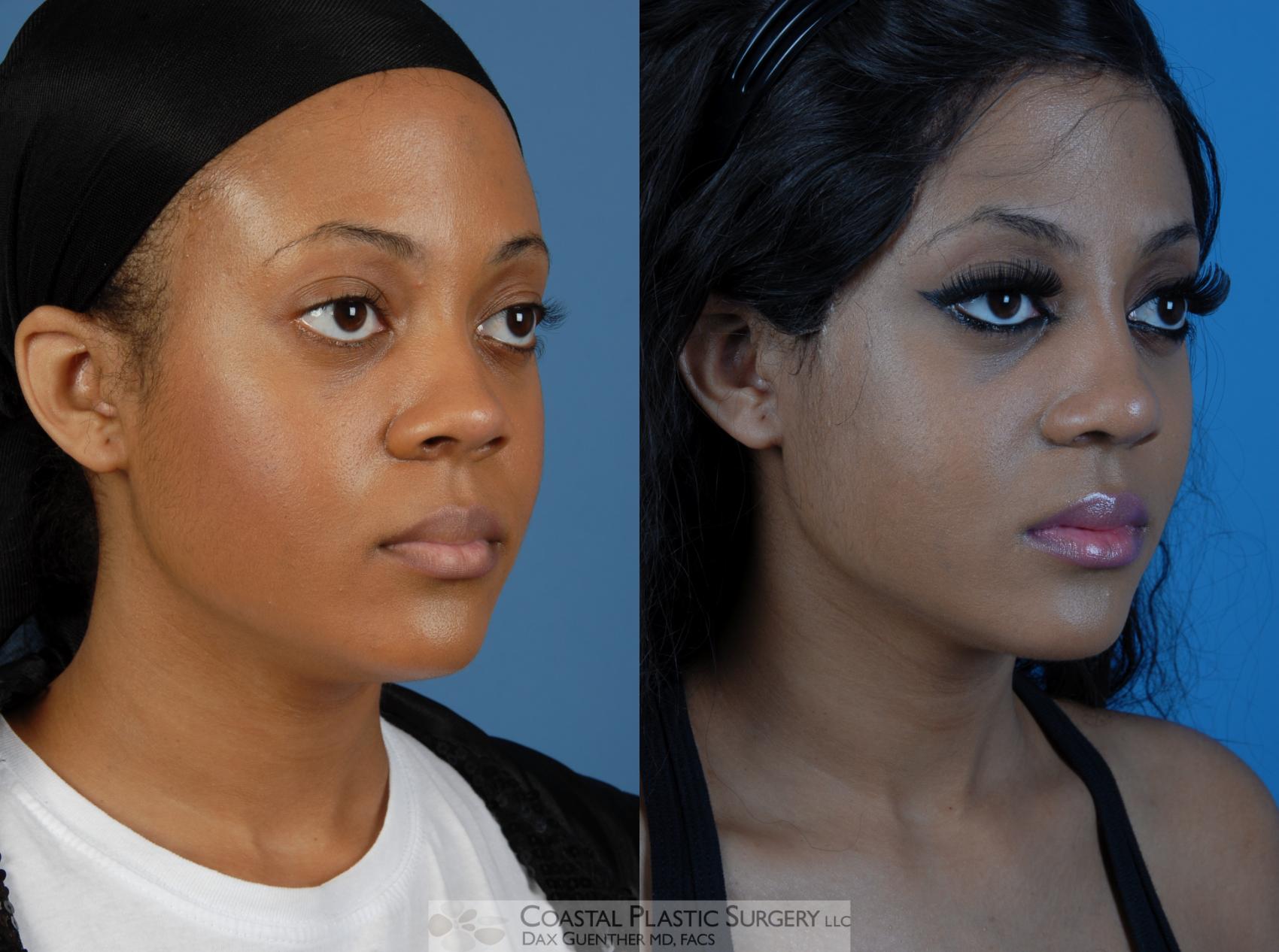 Before & After Rhinoplasty Case 3 View #2 View in Hingham, Boston & Nantucket, MA