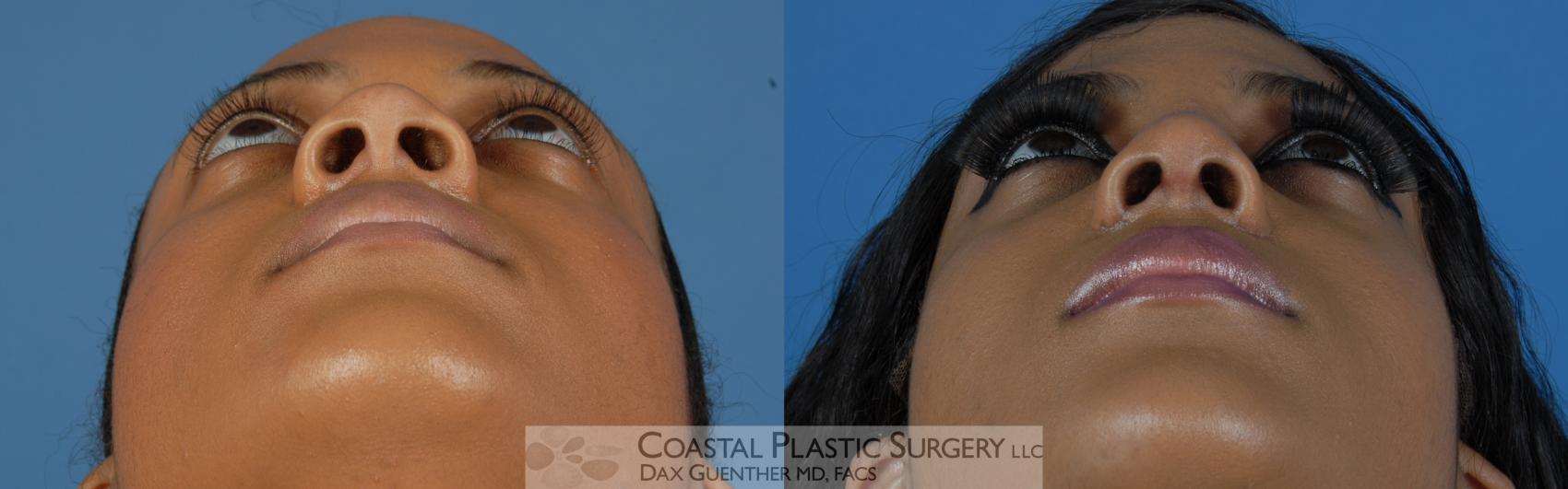 Before & After Rhinoplasty Case 3 View #3 View in Hingham, Boston & Nantucket, MA