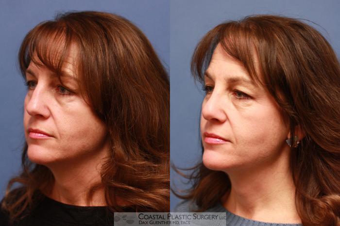 Before & After Rhinoplasty Case 71 View #4 View in Boston, MA