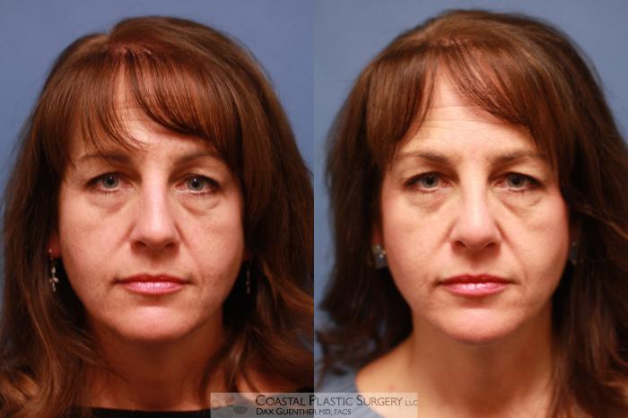 Before & After Rhinoplasty Case 71 View #5 View in Boston, MA