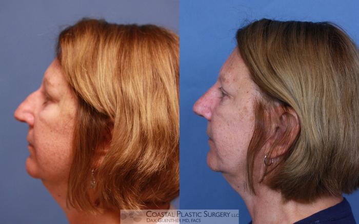 Before & After Rhinoplasty Case 99 View #1 View in Hingham, MA