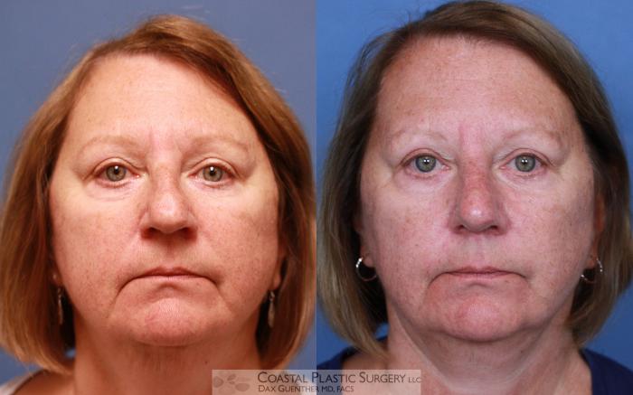 Before & After Rhinoplasty Case 99 View #2 View in Hingham, MA
