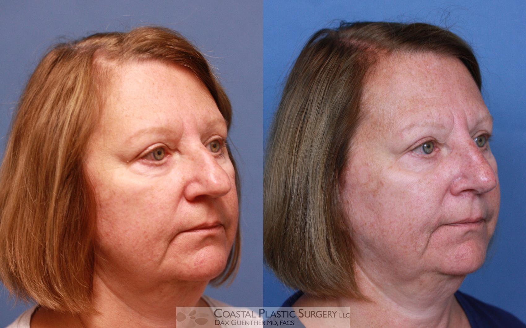 Before & After Rhinoplasty Case 99 View #3 View in Hingham, Boston & Nantucket, MA