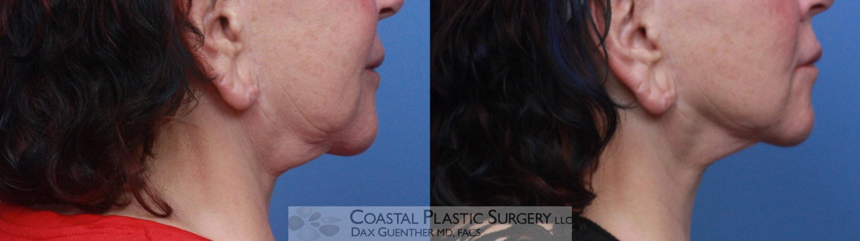 Before & After Skin Tightening Case 120 Right Side View in Hingham, MA