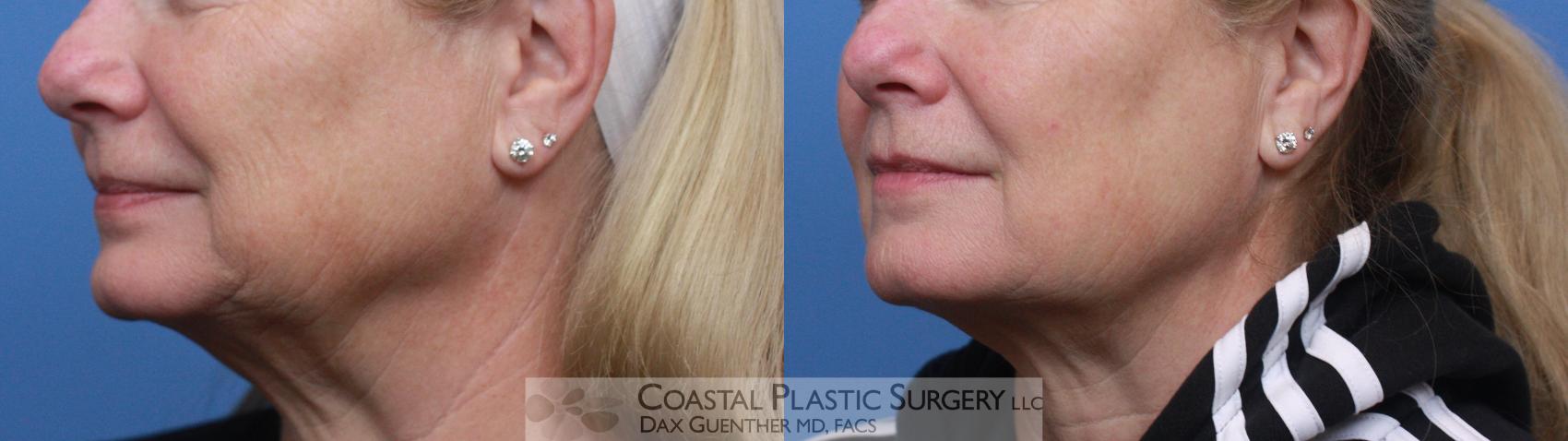 Before & After Skin Tightening Case 121 Left Oblique View in Hingham, MA