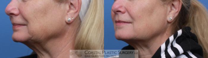 Before & After Skin Tightening Case 121 Left Oblique View in Boston, MA
