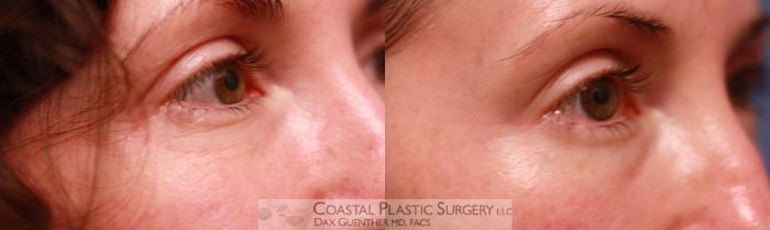 Before & After Skin Tightening Case 73 View #1 View in Boston, MA