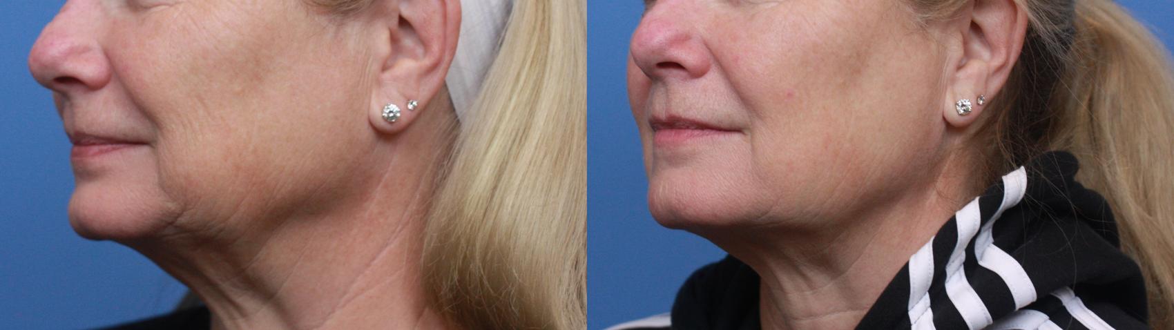 Before & After Skin Tightening & Collagen Induction Therapies Case 121 Left Oblique View in Boston, MA