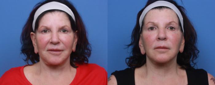 Before & After Skin Tightening & Collagen Induction Therapies Case 128 Front View in Boston, MA