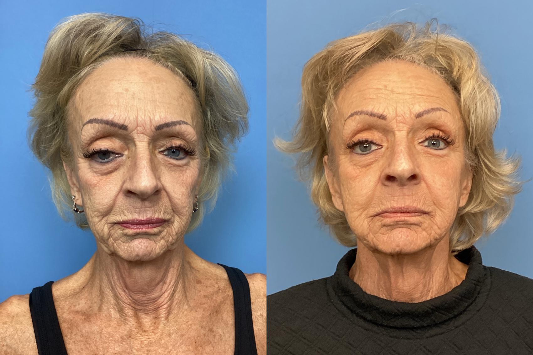 Before & After Skin Tightening & Collagen Induction Therapies Case 129 Front View in Boston, MA