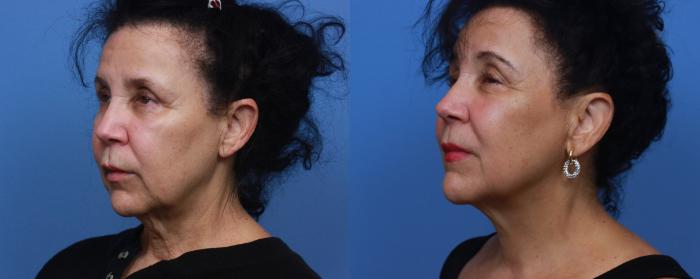 Before & After Skin Tightening & Collagen Induction Therapies Case 130 Left Oblique View in Boston, MA