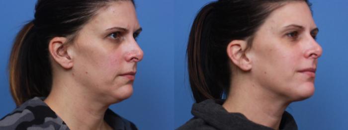 Before & After Skin Tightening & Collagen Induction Therapies Case 131 Right Oblique View in Boston, MA