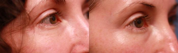 Before & After Skin Tightening & Collagen Induction Therapies Case 73 Right Oblique View in Boston, MA