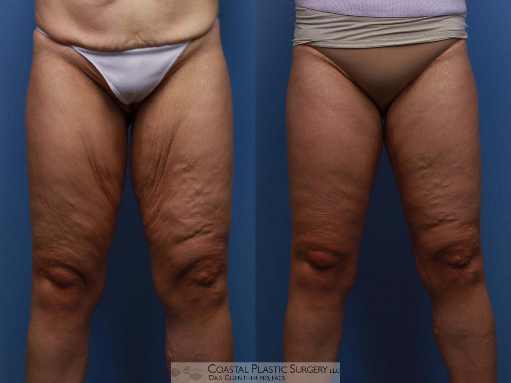 Before & After Thigh Lift Case 134 Front View in Boston, MA