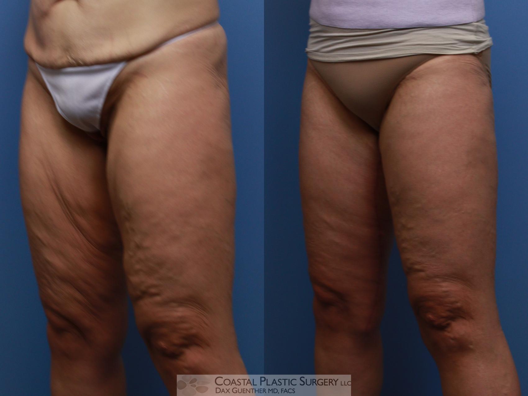 Before & After Thigh Lift Case 134 Left Oblique View in Boston, MA