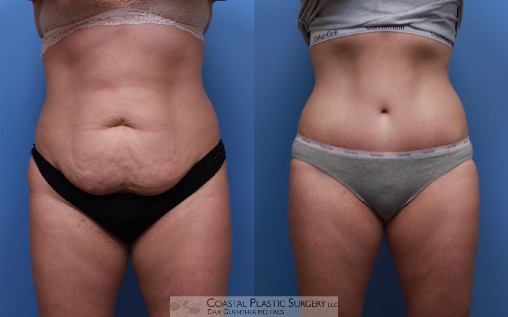 Before & After Tummy Tuck (Abdominoplasty) Case 123 Front View in Boston, MA