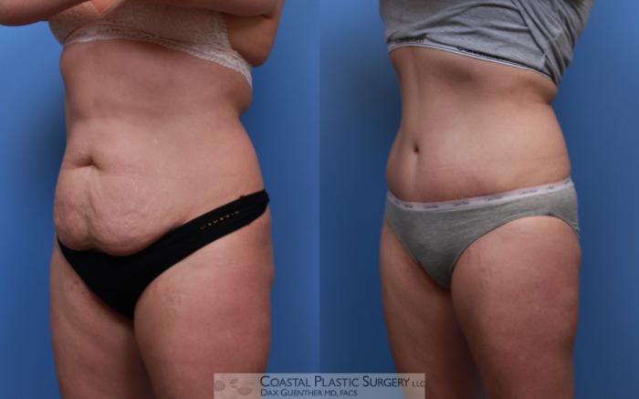 Before & After Tummy Tuck (Abdominoplasty) Case 123 Left Oblique View in Boston, MA