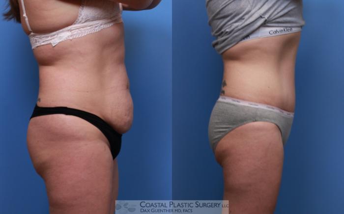 Before & After Tummy Tuck (Abdominoplasty) Case 123 Right Side View in Boston, MA