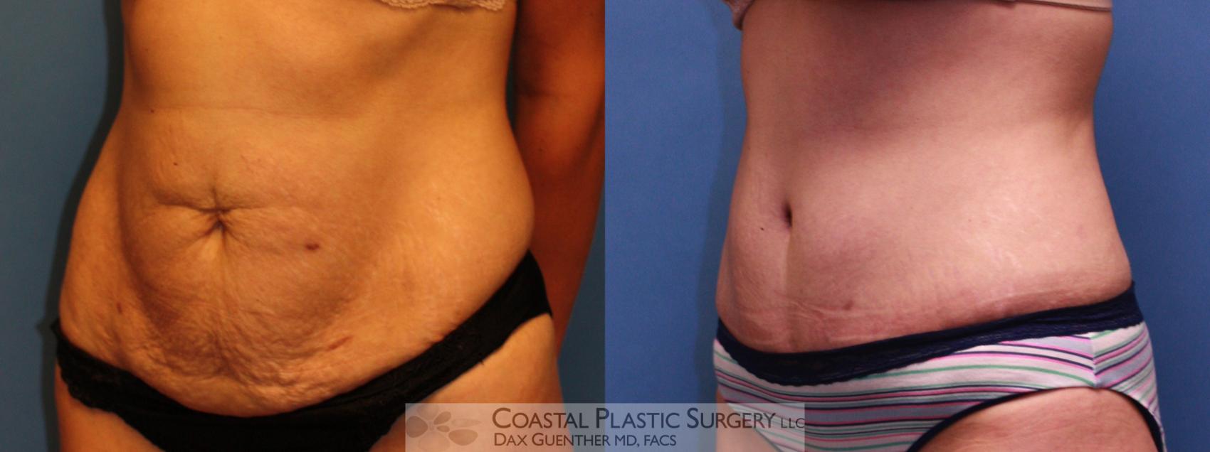 Before & After Tummy Tuck (Abdominoplasty) Case 13 View #1 View in Hingham, Boston & Nantucket, MA