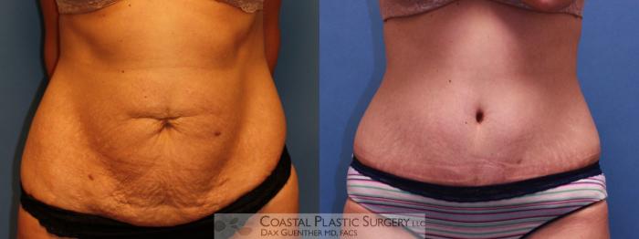Before & After Tummy Tuck (Abdominoplasty) Case 13 View #2 View in Boston, MA