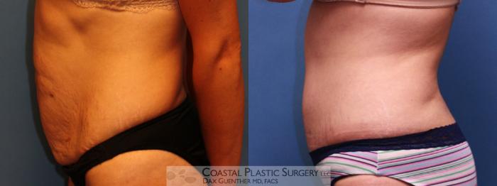 Before & After Tummy Tuck (Abdominoplasty) Case 13 View #3 View in Boston, MA