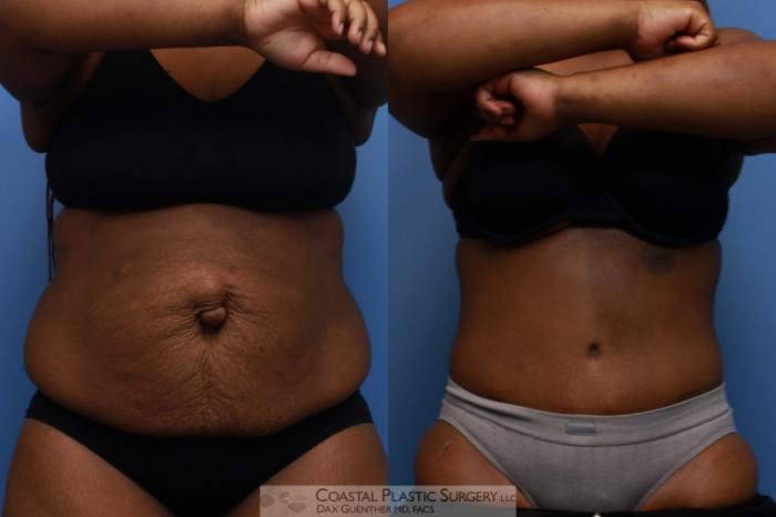 Before & After Tummy Tuck (Abdominoplasty) Case 136 Front View in Boston, MA
