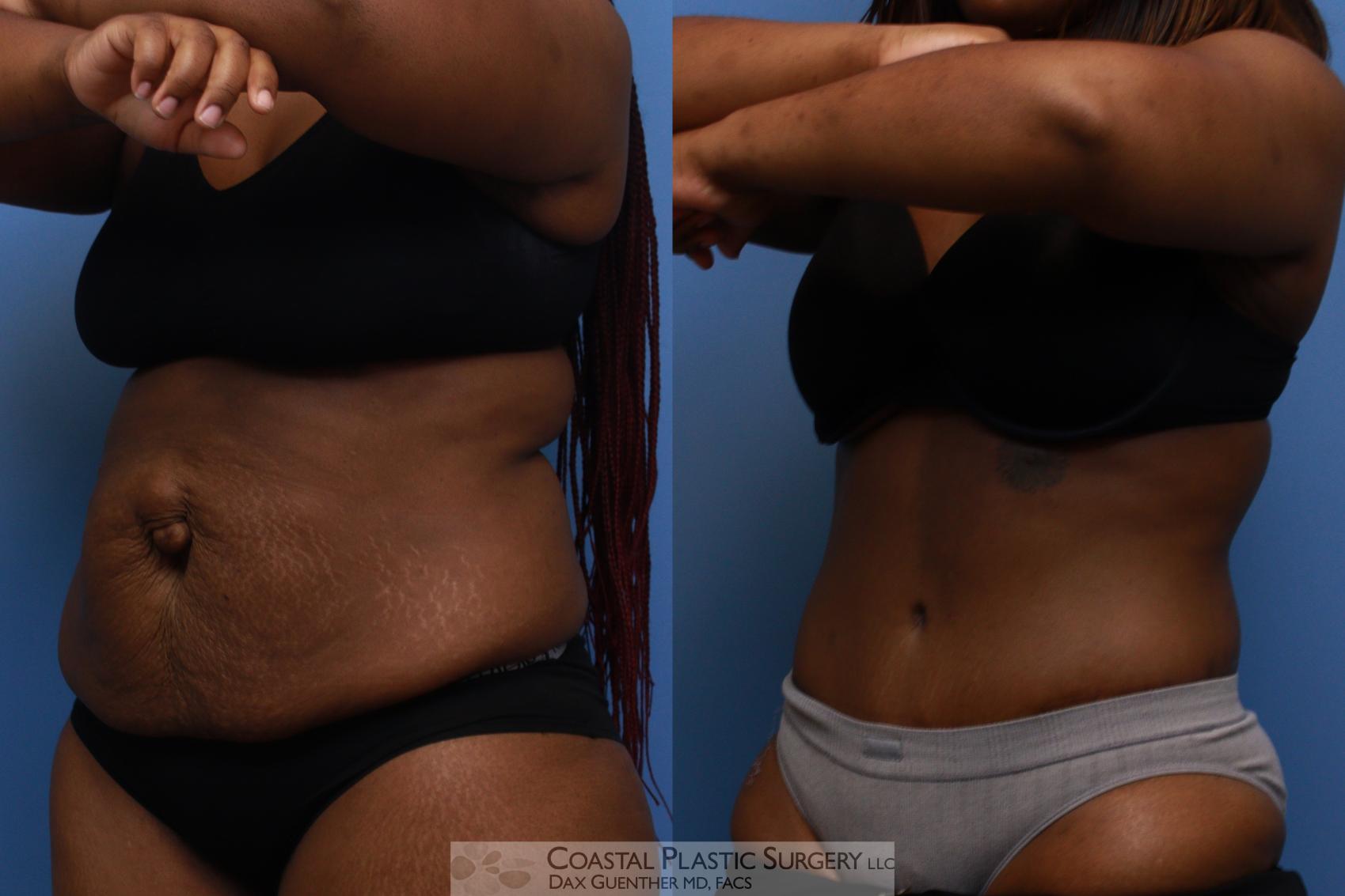 Before & After Tummy Tuck (Abdominoplasty) Case 136 Left Oblique View in Boston, MA