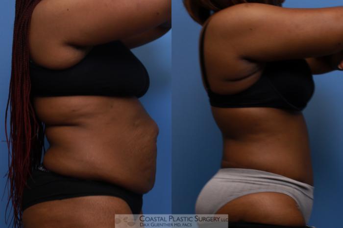 Before & After Tummy Tuck (Abdominoplasty) Case 136 Right Side View in Boston, MA