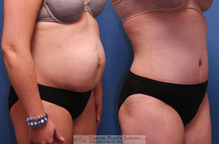 Before & After Tummy Tuck (Abdominoplasty) Case 17 View #3 View in Hingham, MA