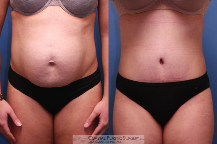 Before & After Tummy Tuck (Abdominoplasty) Case 17 View #4 View in Boston, MA