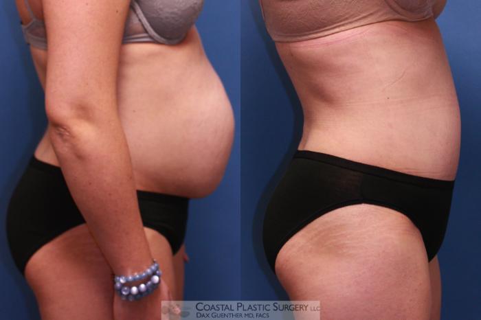 Before & After Tummy Tuck (Abdominoplasty) Case 17 View #5 View in Boston, MA