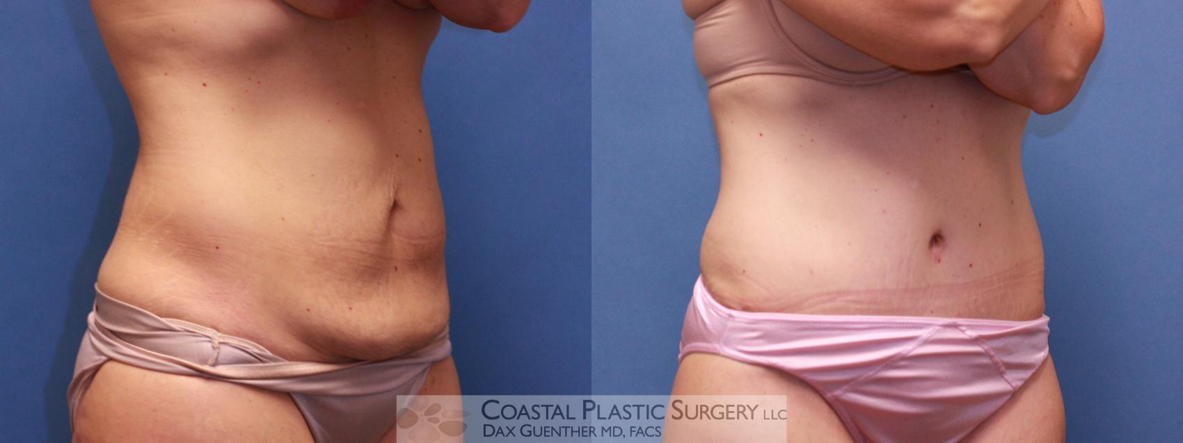 Before & After Tummy Tuck (Abdominoplasty) Case 27 View #1 View in Boston, MA