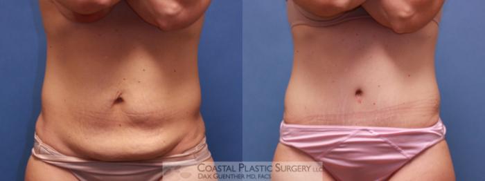 Before & After Tummy Tuck (Abdominoplasty) Case 27 View #3 View in Boston, MA