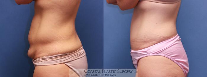 Before & After Tummy Tuck (Abdominoplasty) Case 27 View #4 View in Boston, MA