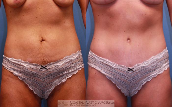 Before & After Tummy Tuck (Abdominoplasty) Case 43 View #2 View in Boston, MA
