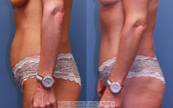 Before & After Tummy Tuck (Abdominoplasty) Case 43 View #3 View in Boston, MA